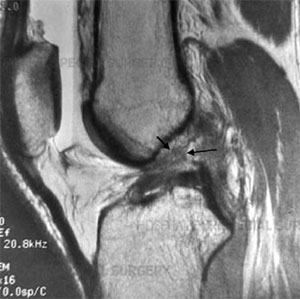 MRI of Complete ACL Tear