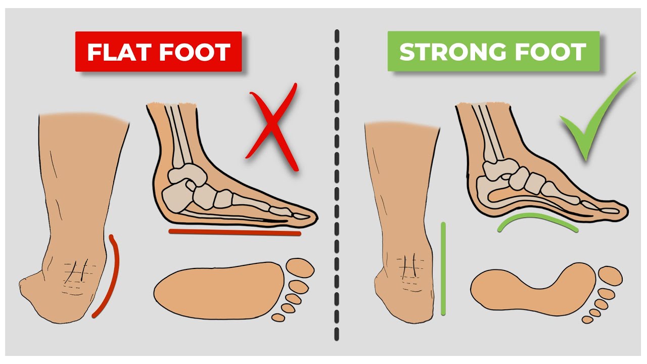 How to Fix Flat Feet (fallen arches) in 4 Steps - YouTube