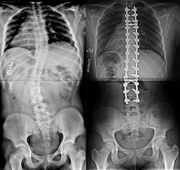 http://www.spinemd.com/cache/images/scoliosis_ervin_compare_AP_610_576_80.jpg
