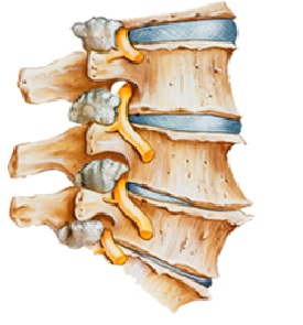 Physiotherapy Oakville: Cervical Spondylosis