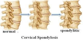 Understanding Cervical Spondylosis | QI Spine