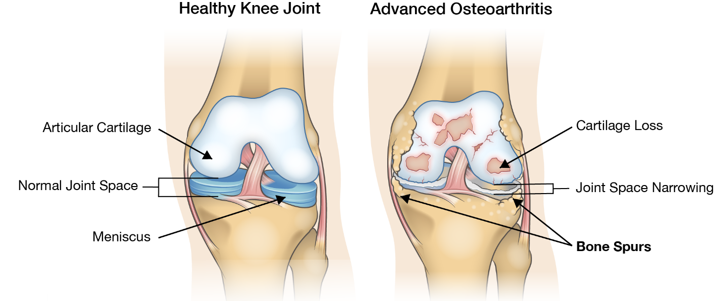 Guide to Severe Knee Arthritis (Tricompartmental Osteoarthritis) - Spring  Loaded Technology