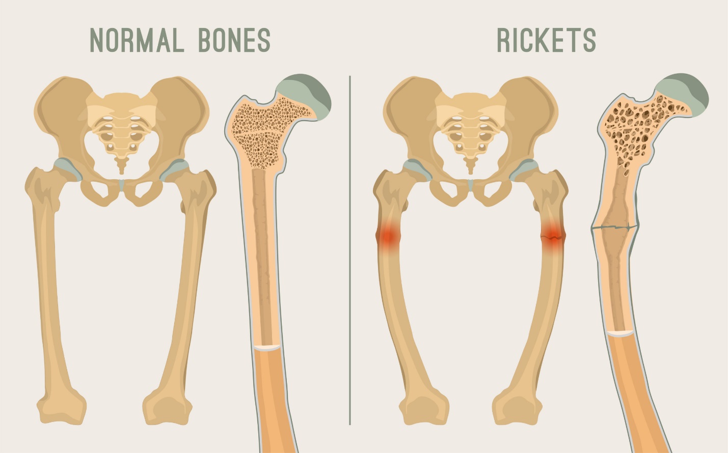 Rickets: All You Wanted to Know - Apollo Hospitals Blog
