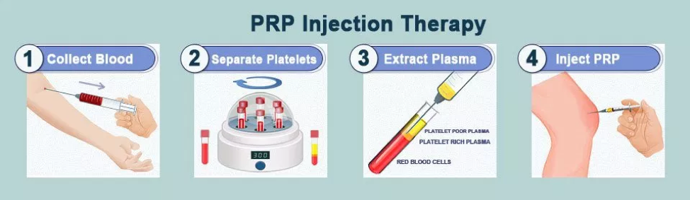 PRP and Stem cell therapy for orthopedic conditions