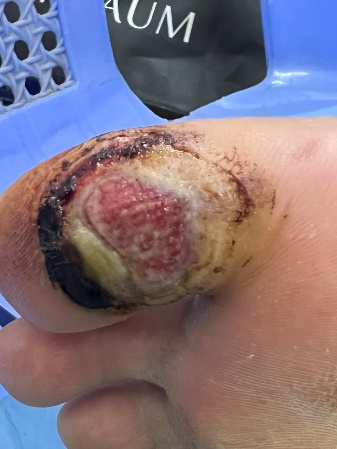 A close up of a toe with a wound

Description automatically generated