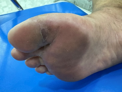 A foot with a bruise on it

Description automatically generated