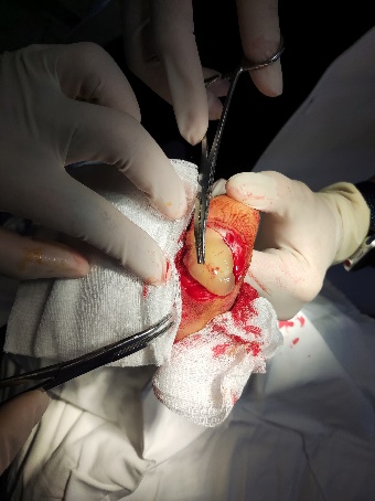 A person performing surgery on a wound

Description automatically generated with medium confidence