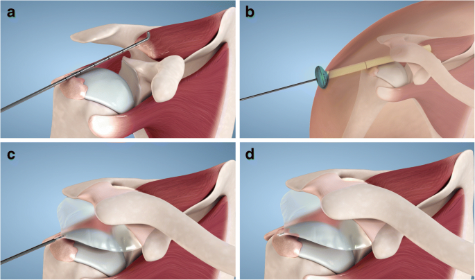 Comparative cost-effectiveness analysis of the subacromial spacer for  irreparable and massive rotator cuff tears | International Orthopaedics