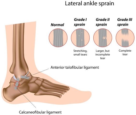 Ankle Injury Treatment Melbourne - Sprains, fractures, rehab and surgery.