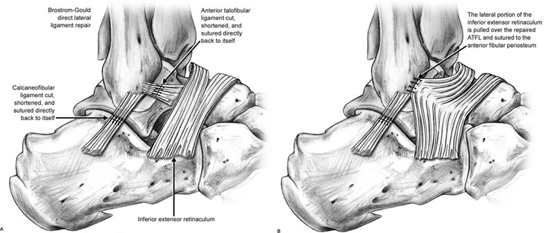 Ankle Ligament Reconstruction (Brostrum repair) | Peter Rosenfeld FRCS,  London