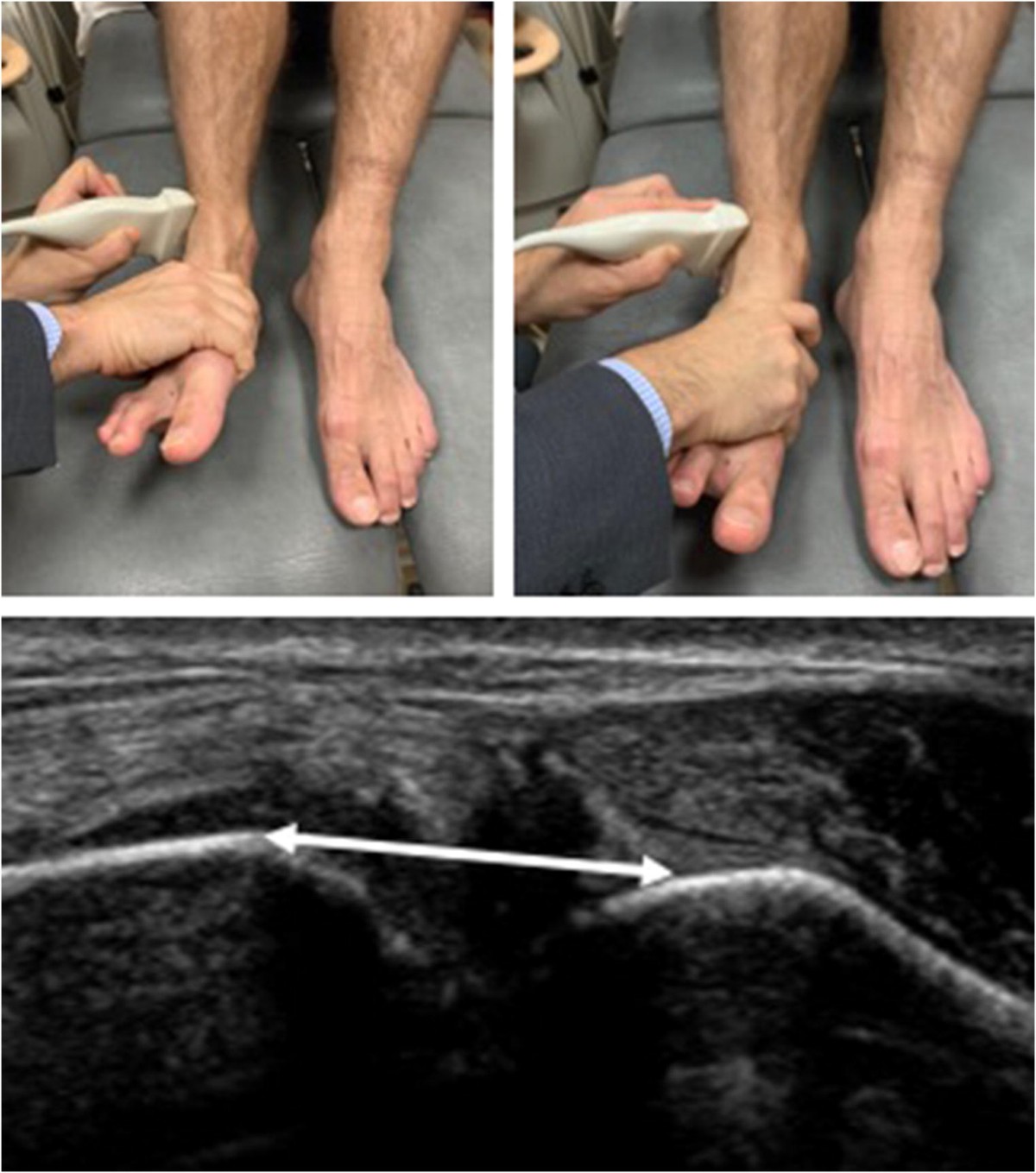 Diagnostic value of ultrasonography in acute lateral and syndesmotic  ligamentous ankle injuries | European Radiology