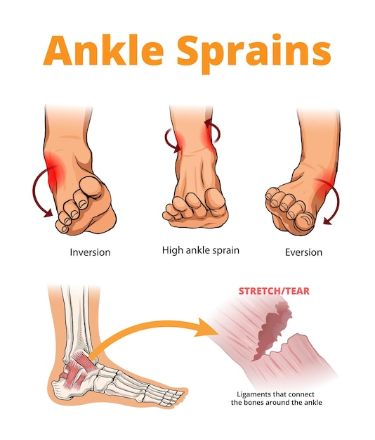 Illustration of ankle sprains types | Premium Vector