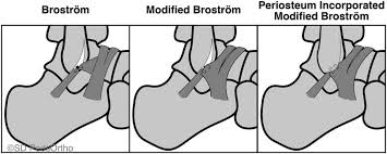 Intermediate-term Outcomes in Adolescent Recurrent Ankle Instability  Managed With a Modified Broström- Gould Procedure Augmente