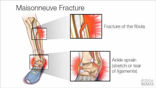 Mayo Clinic Q and A: Untreated Maisonneuve fracture - Mayo Clinic News  Network