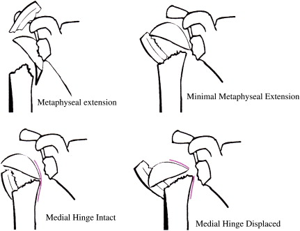 Classification and Imaging of Proximal Humerus Fractures - ScienceDirect