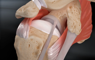 New Technology for Rotator Cuff Tears | Dr. Sara Jurek