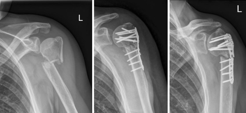One case of plate failure due to non-union of the fracture | Download  Scientific Diagram