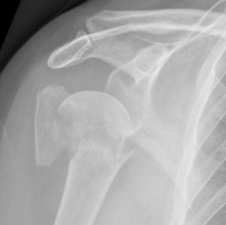 Proximal Humerus Fractures - Trauma - Orthobullets