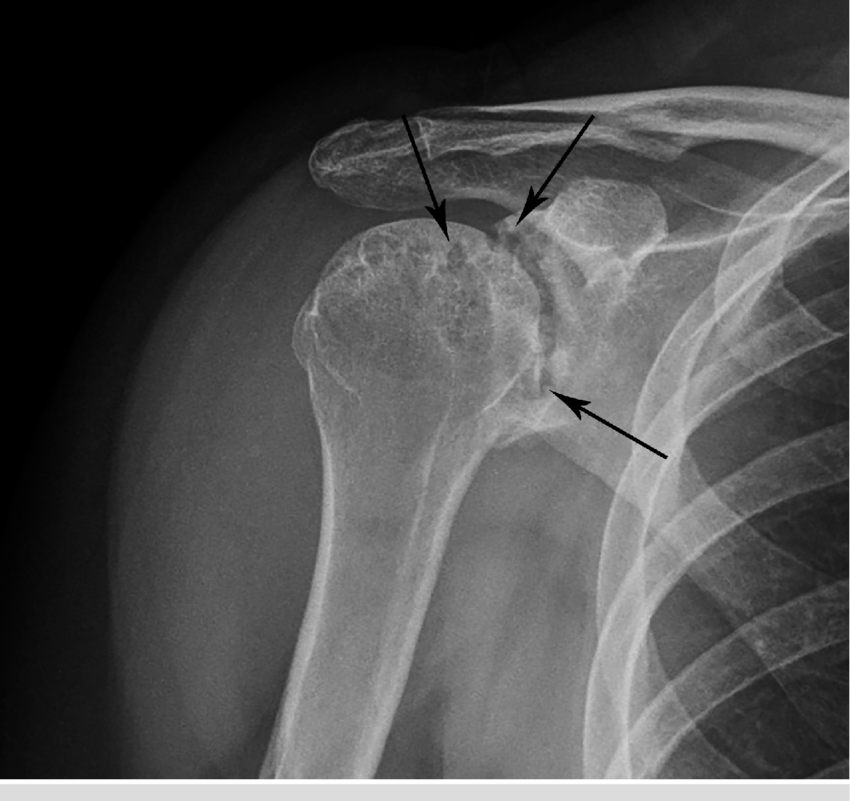 Radiograph of the Right Shoulder in this 28-Year- Old Female with... |  Download Scientific Diagram