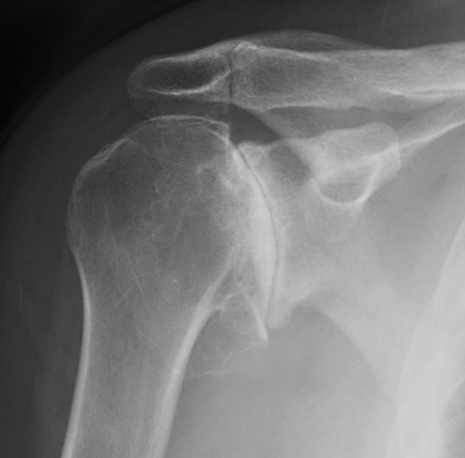 Shoulder Arthritis (Glenohumeral Arthritis) | Frisco, TX | Orthopedic  Surgeon