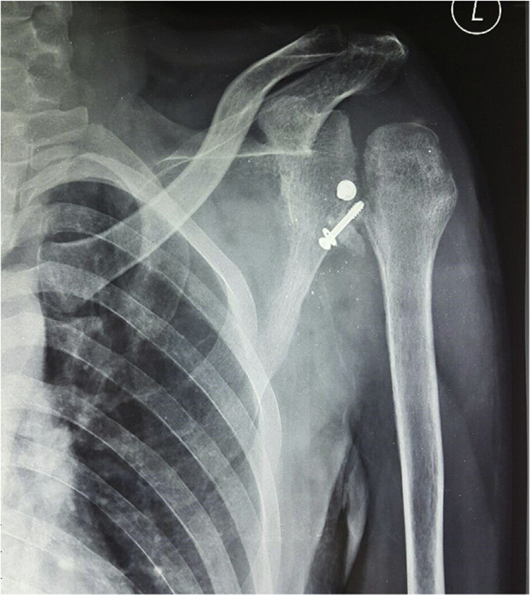 Three months post-operative X-ray antero-posterior view of the left... |  Download Scientific Diagram