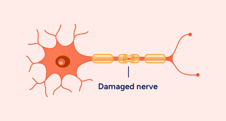 A diagram of a damaged nerve AI-generated content may be incorrect.