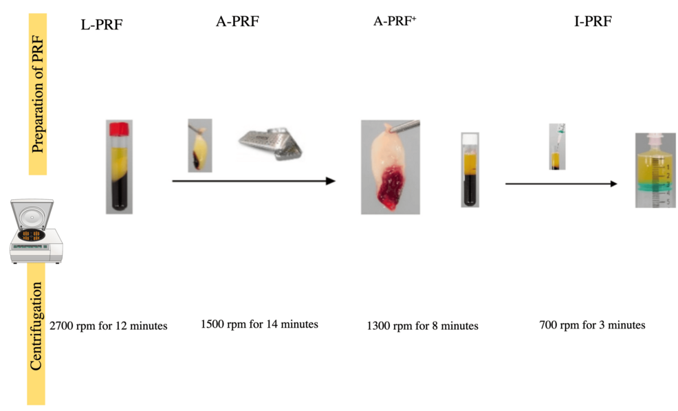 From Healing to Regeneration: A Comprehensive Review of the Efficacy of  Platelet-Rich Fibrin in Periodontal Plastic Surgery Procedures | Cureus