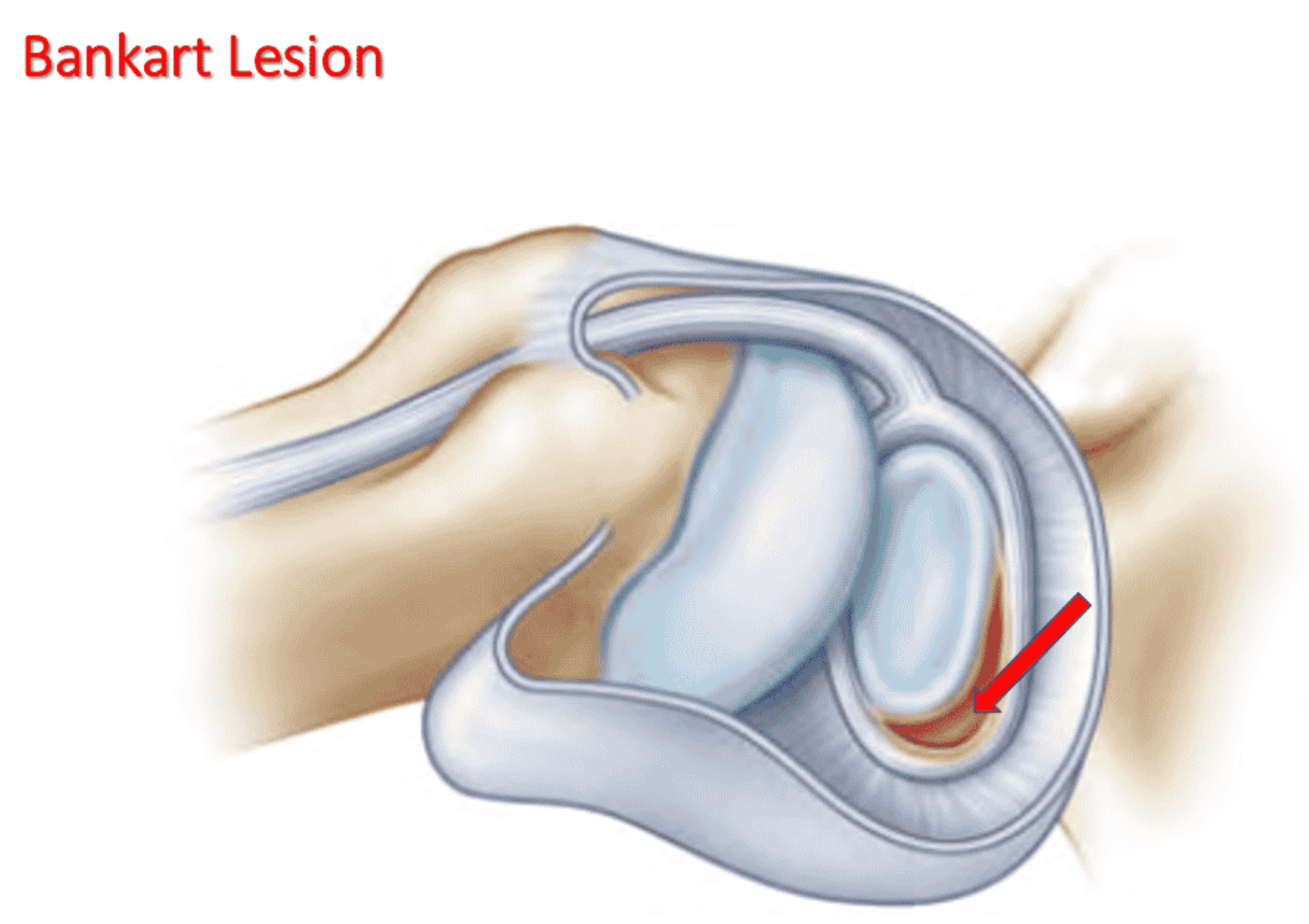Tổn thương Bankart