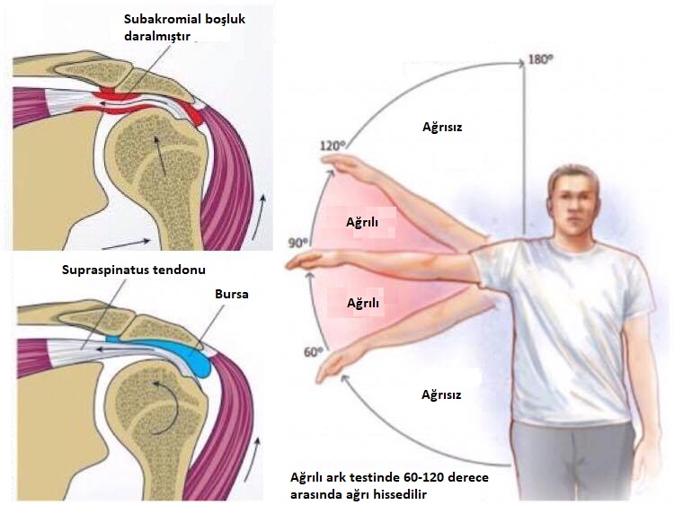 Cơ chế impingement dưới mỏm cùng vai