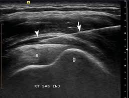 Tiêm corticosteroid dưới hướng dẫn siêu âm