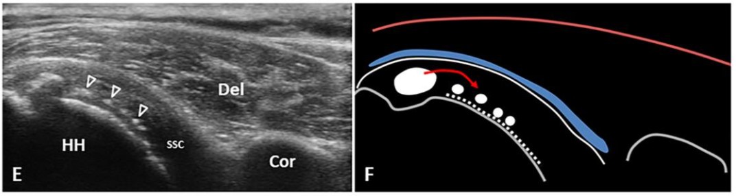 SA Post-calcific frozen shoulder