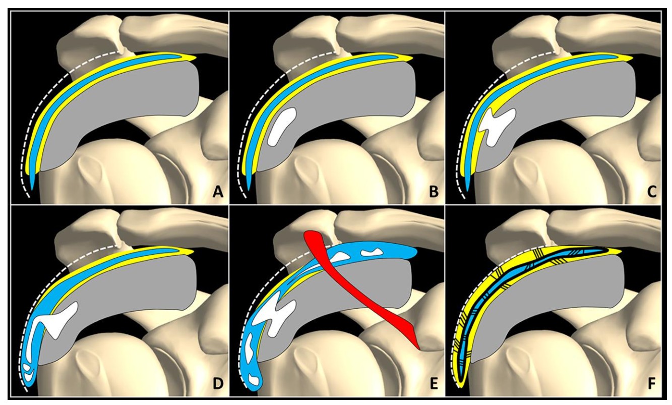 SA Bursal migration progression