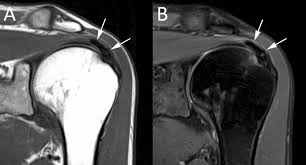 MRI coronal gân trên gai vôi hóa