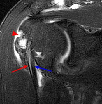 MRI vai — dịch quanh LHBT và SASD bursitis