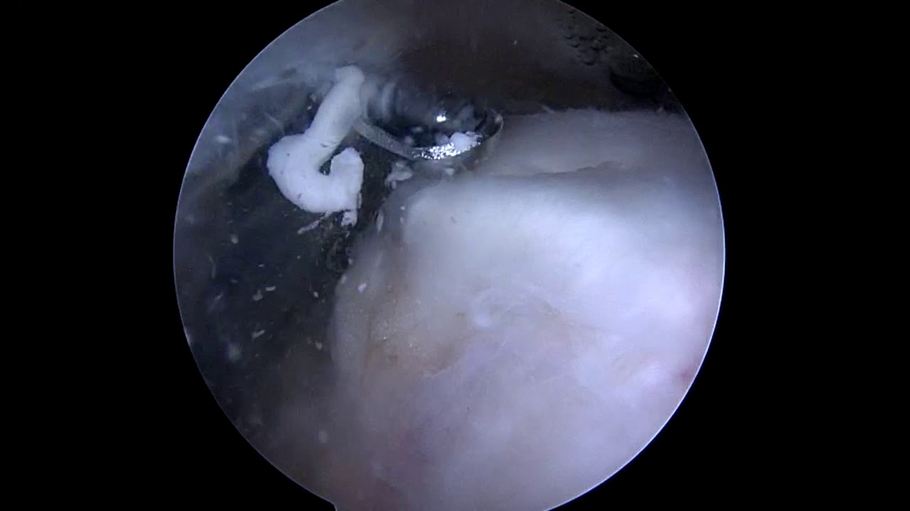 Phẫu thuật nội soi lấy vôi và sửa gân