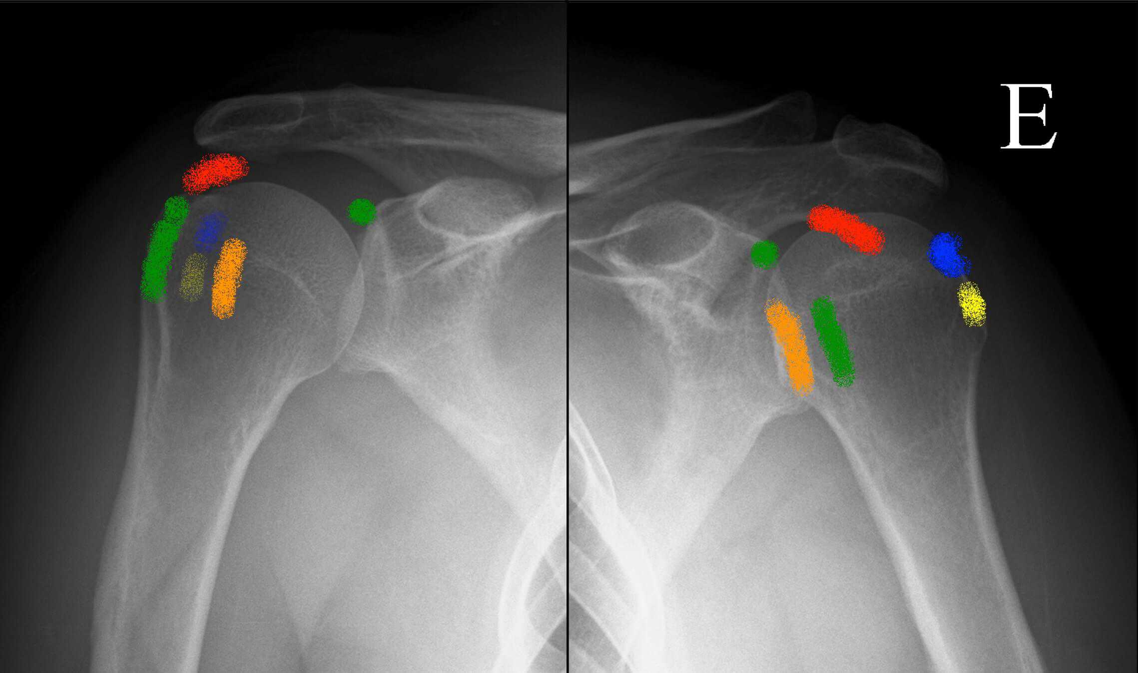 Phân bố giải phẫu vôi hóa gân chóp xoay