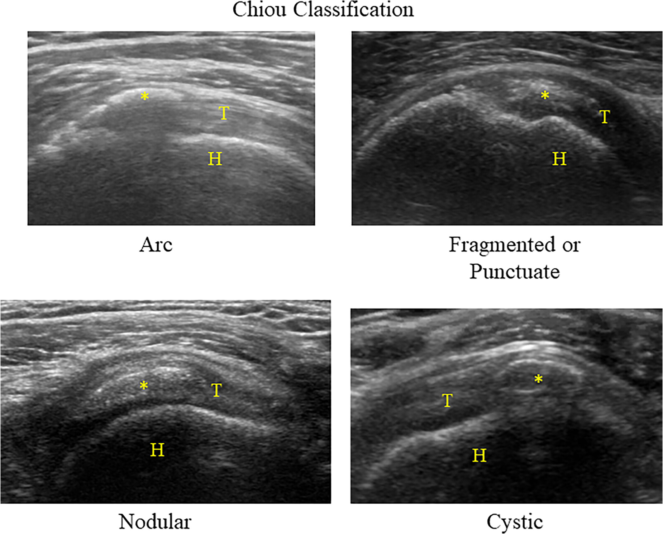 Hình ảnh siêu âm gân trên gai