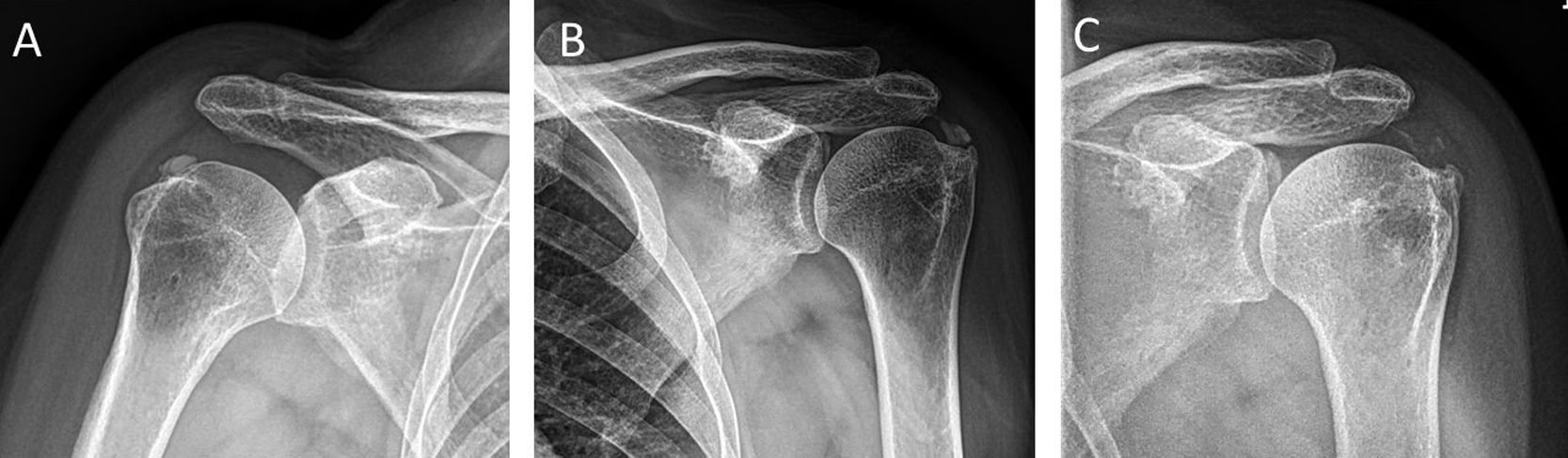 Phân loại Gärtner trên X-quang