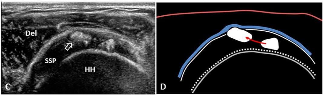 SA Resorptive phase migration