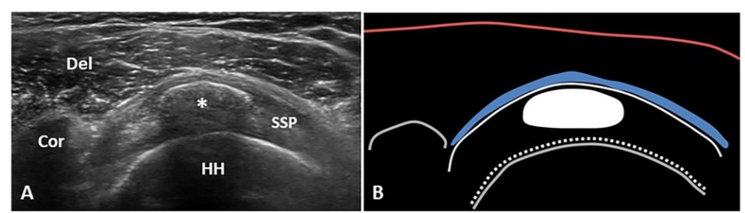 SA Resting phase arc shadowing