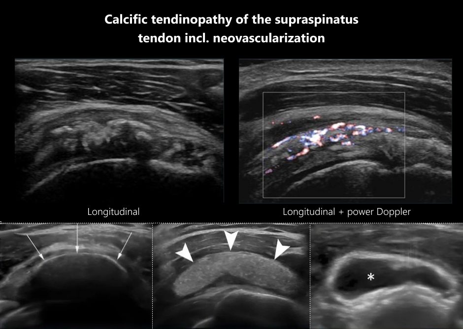 SA follow-up before after barbotage