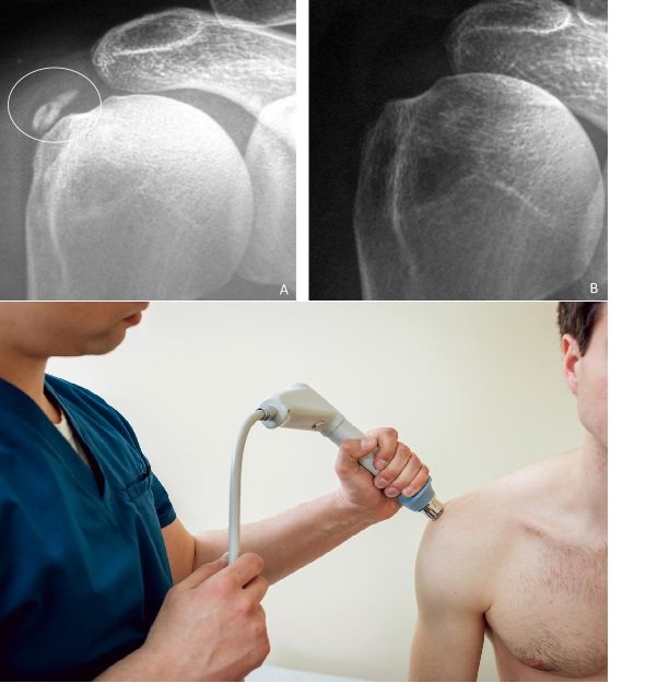 ESWT X-quang trước và sau điều trị