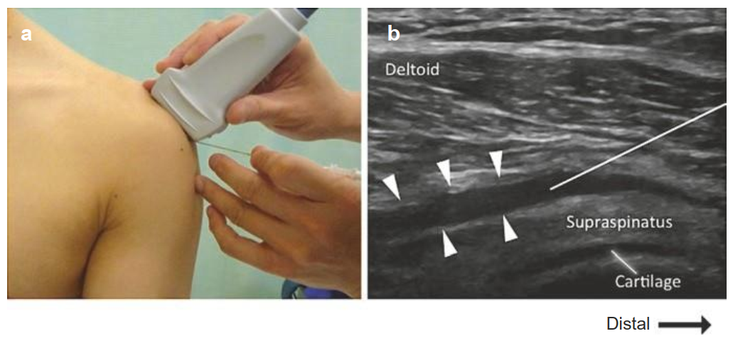Barbotage technique US-guided
