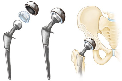 Cấu tạo khớp háng nhân tạo toàn phần