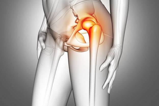Đau vùng khớp háng sau té ngã – dấu hiệu gợi ý gãy cổ xương đùi