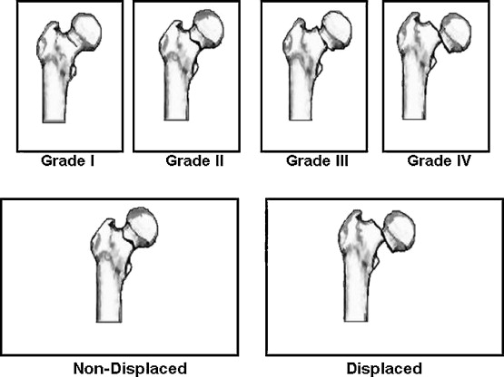 Phân độ Garden I đến IV của gãy cổ xương đùi
