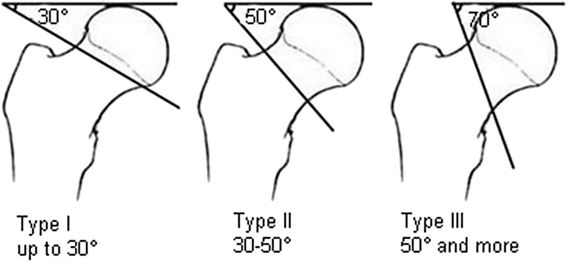 Phân độ Pauwels I, II, III theo góc đường gãy cổ xương đùi